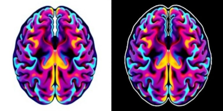 Study Reveals Brain Structure Variations Linked to Early Substance Use in