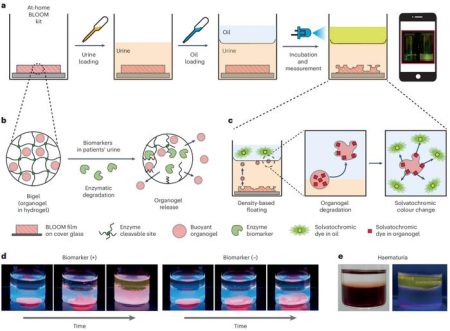 At-Home Testing for Early Detection of Bladder Cancer: A Breakthrough