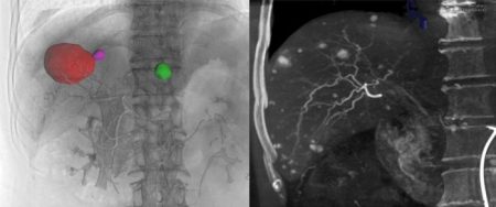 Experts Reach Consensus on Cone-Beam CT Utilization in Interventional Liver