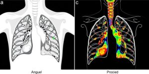 Exploring Morphomic Predictors: Insights into Post-Esophagectomy Pulmonary