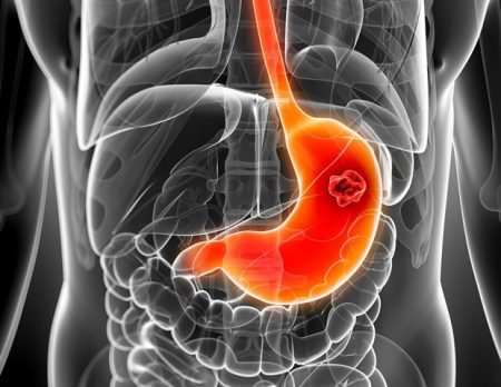 Scientists uncover hints of a potential new cause of stomach cancer