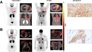 New Radiotracer Uncovers Biomarker Associated with Triple-Negative Breast